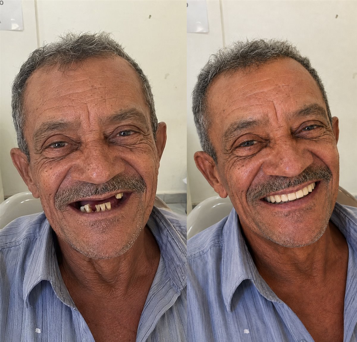 Antes e depois de paciente da Odonto Excellence que recuperou os dentes fixos